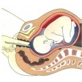 Szúrt húgyhólyag membránok (amniotomy) - jelzések, eljárás leírása, szövődmények