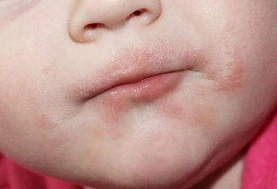Az megnyilvánulása az allergia anaferon