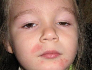 Az megnyilvánulása az allergia anaferon