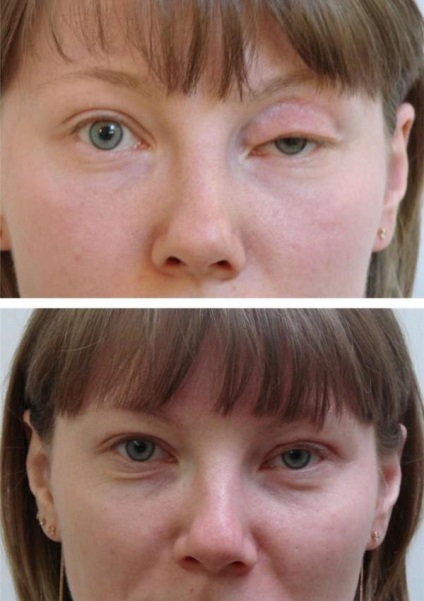 Ptosis, a felső szemhéj okoz, kezelés népi jogorvoslati műtét nélkül, miután Botox otthon