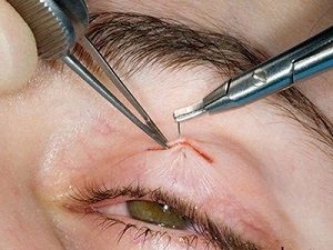 Ptosis felső szemhéj műtét vagy a kezelést anélkül, sebészetileg