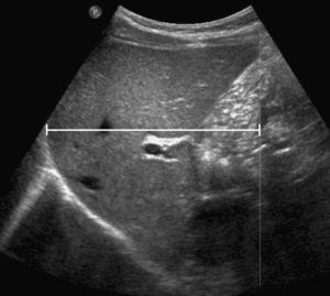 Méretek a máj és az epehólyag ultrahang (Lecture on diagnostere) (máj) Méretek a máj és az epehólyag ultrahang (Lecture on diagnostere)
