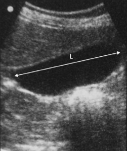 Méretek a máj és az epehólyag ultrahang (Előadás diagnostere) (gall) Méretek a máj és az epehólyag ultrahang (Lecture on diagnostere)