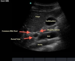 Méretek a máj és az epehólyag ultrahang (Előadás diagnostere) (gall) Méretek a máj és az epehólyag ultrahang (Lecture on diagnostere)