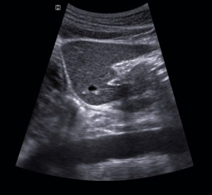 Méretek a máj és az epehólyag ultrahang (Lecture on diagnostere) (méretek) Méretek a máj és az epehólyag ultrahang (Lecture on diagnostere)