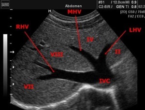 Méretek a máj és az epehólyag ultrahang (Előadás diagnostere) (gall) Méretek a máj és az epehólyag ultrahang (Lecture on diagnostere)