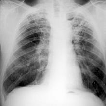 Radiológiai módszerek tuberkulózis diagnosztika