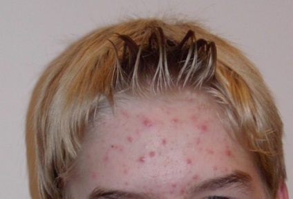 Seborrhoea a bőr az arcon és népszerű receptek dermatitis