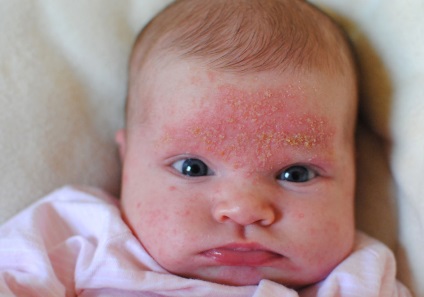Seborrhoeás dermatitis az arcon -, mit és hogyan kell kezelni