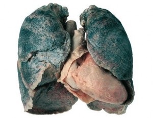 Tünetei és kezelése pulmonalis sarcoidosis