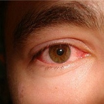 Vörös szem szindróma tünetei, diagnózisa és kezelése