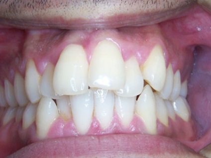Crowding fogak fotó patológia és annak kezelése