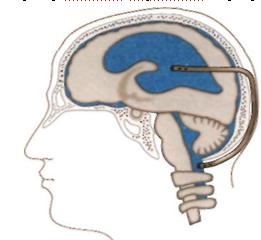 Modern kezelési módszerek hydrocephalus - következményeinek agyödéma