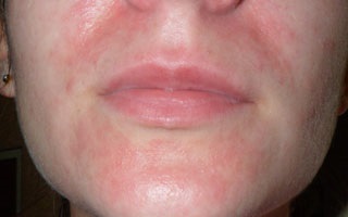 Szteroid dermatitis - okai, tünetei és kezelése (fotó)
