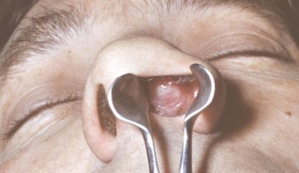 Stretpokokk orrát a gyermek kezelése Streptococcus orrgarat (orrgarat) Stretpokokk orrát a gyermek kezelése streptococcus az orrgarat