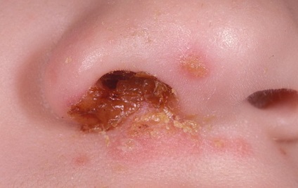 Stretpokokk orrát a gyermek kezelése streptococcus az orrgarat