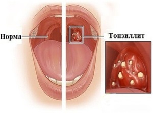 Tonsillitis krónikus tünetek, komplikációk, kezelése a mandulák