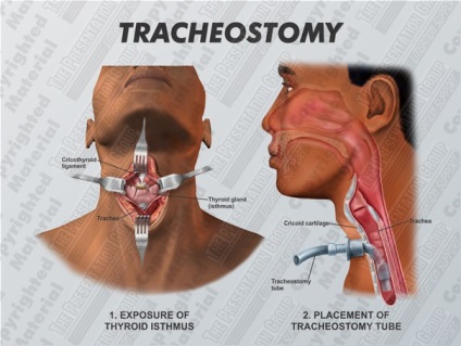 Tracheotómia - műtét terén (a helyszínen) Tracheotómia - Sebészet szántóföldi körülmények között