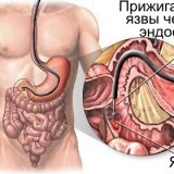 Nehéz lenyelni a szonda szikét - orvosi információk és oktatási portál