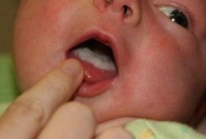 A csecsemők fehér nyelv bevonat, vagy hogyan kell eltávolítani a szájpenész (fehér) A csecsemők fehér foltok a nyelv vagy eltávolítása szájpenész