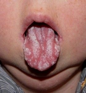 A csecsemők fehér foltok a nyelv vagy eltávolítása szájpenész