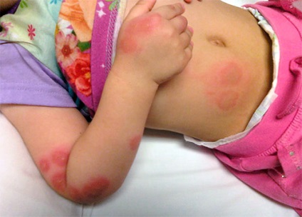 Poloska csípése gyermekeknél (fotó), és mi a teendő, ha egy gyermek megharapott