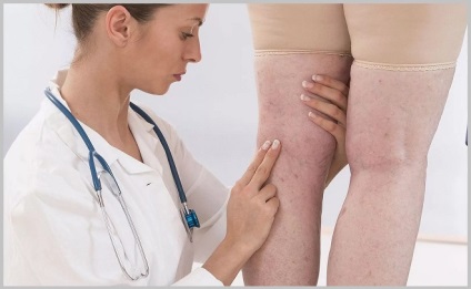 Visszértágulat a lábát a nők, a tünetek, okok, kezelés, megelőzés