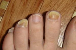 gombás köröm láb kórokozó nail gomba kezelésére kolpino