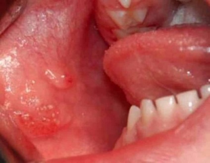 fehér hólyag a szájban magas vércukorszint gyógyszeres kezelése