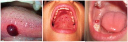 Hólyagok a szájban, hogy ez okozza a megjelenése vizes és a vér (piros) buborékok a szájüregben és a