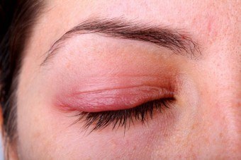 Az egyik szem szemhéjának duzzanata: okai és kezelése - Allergének