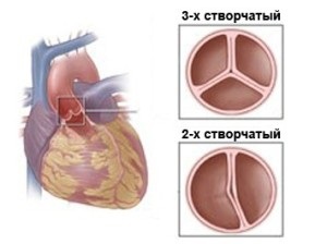 UPU két összecsukható az aortabillentyű