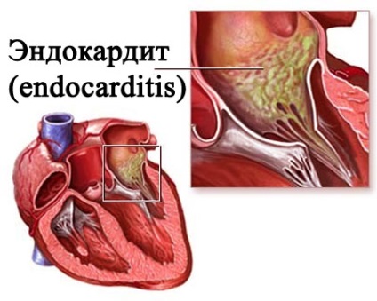 UPU két összecsukható az aortabillentyű