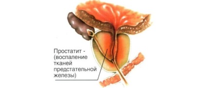 Krónikus prosztatagyulladás abacterial - jellemzői és a kezelés