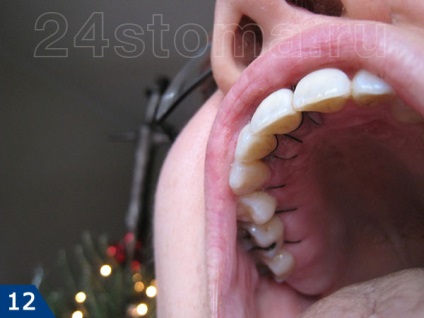 Miért kell tennem abrasióra foghústasakokat - lebeny műtét parodontitis