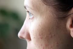 Allergiás bőrkiütést az arcon