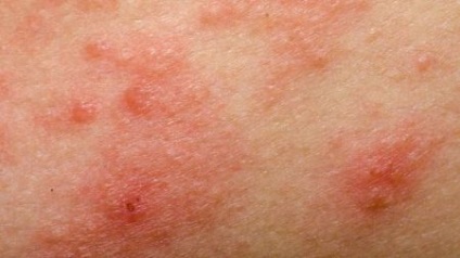 Allergiás bőrgyulladás tünetei, kezelése, fotók