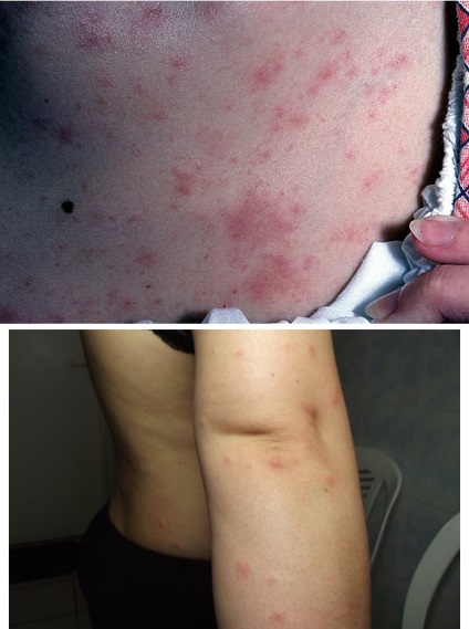 Allergiás bőrgyulladás tünetek, okok, kezelés, fotók