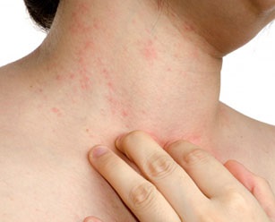 Allergiás bőrgyulladás tünetek, okok, kezelés, fotók