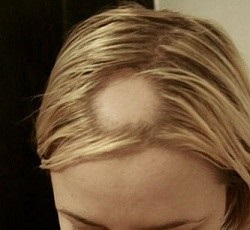 Alopecia női kezelésére, okai és tünetei a női alopecia