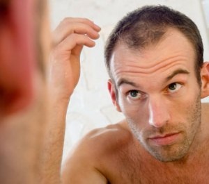 Androgén alopecia (a legtöbb) androgén alopecia