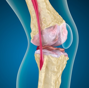 Osteoarthritis hogyan kell megállítani a izületroncsolódás