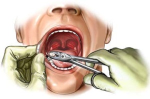 Болить зуб мудрості і ясна в кінці нижньої щелепи що робити, як зняти біль