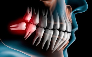 Болить зуб мудрості і ясна в кінці нижньої щелепи що робити, як зняти біль