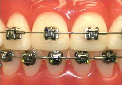 Nadrágtartók - Dental 