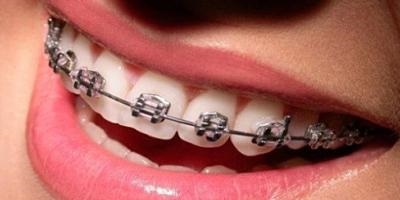 Nadrágtartók - Dental 