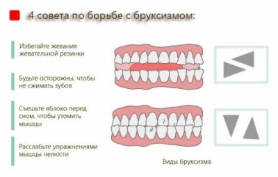 Fogcsikorgatás gyermekeknél okoz, tünetei és kezelése