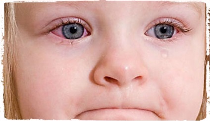 Mint kezelni kötőhártya gyermekek tünetei, kezelése és megelőzése