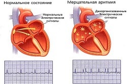 A veszélyes pitvarfibrilláció a szív 1