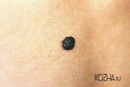 Fekete anyajegy szervezetben okoz feketedés és a megjelenése fekete pontok a vakondok